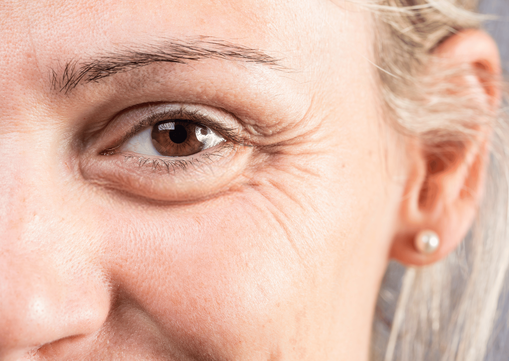 How to Tackle Persistent Under-Eye Bags